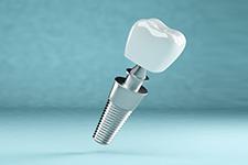 What Should We Pay Attention to in Implant Treatment?